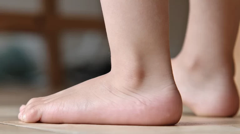 Flat foot