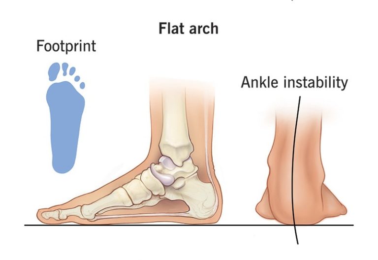 تبسط القدم فلات فوت | Flat foot